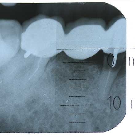 Implant-1-01